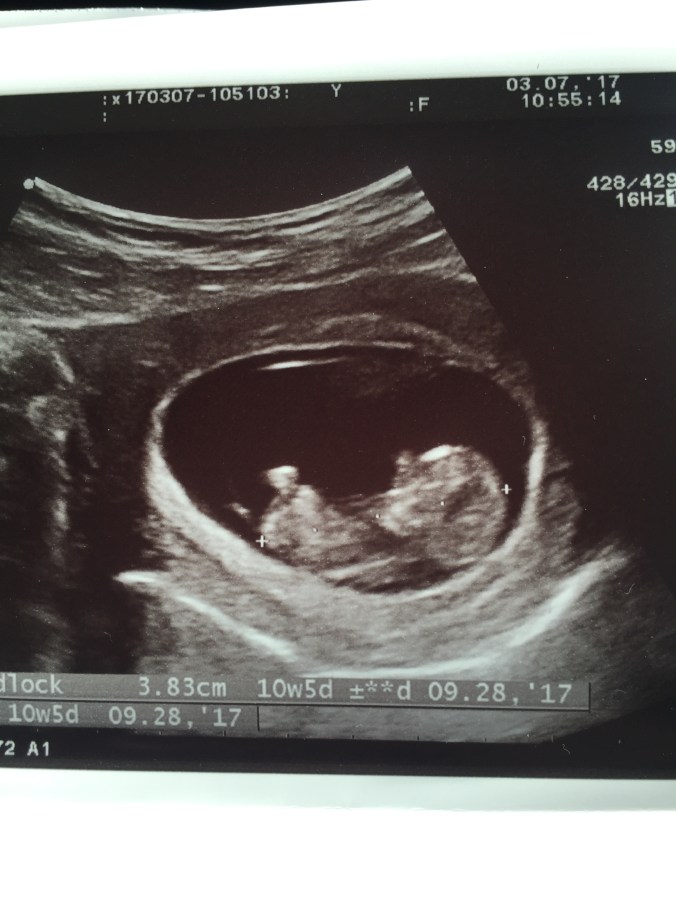 Baby ultrasound picture